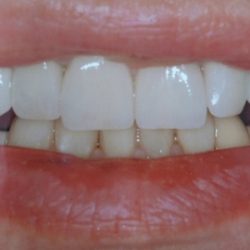 After: teeth that were restored with porcelain crowns