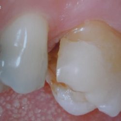 Before: teeth that were restored with porcelain crowns