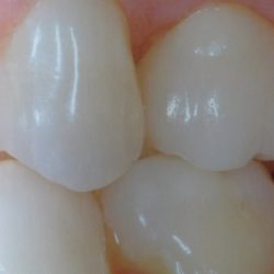 After: teeth that were restored with porcelain crowns