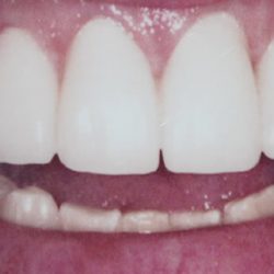 After: Broken teeth that were restored with porcelain crowns