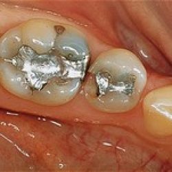 Before: silver amalgam fillings that were replaced with white composite fillings