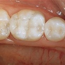 After: silver amalgam fillings that were replaced with white composite fillings