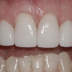 After: closing of the diastema with porcelain veneers