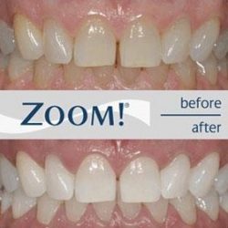 Before and After picture of Teeth Whitening